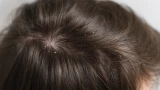 Перхоть: почему возникает и как вернуть здоровье коже головы