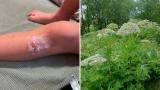 В Заполярье первые жертвы борщевика: опасные заросли никто не косит