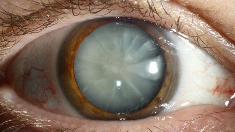 Катаракта глаза лечение петрозаводск