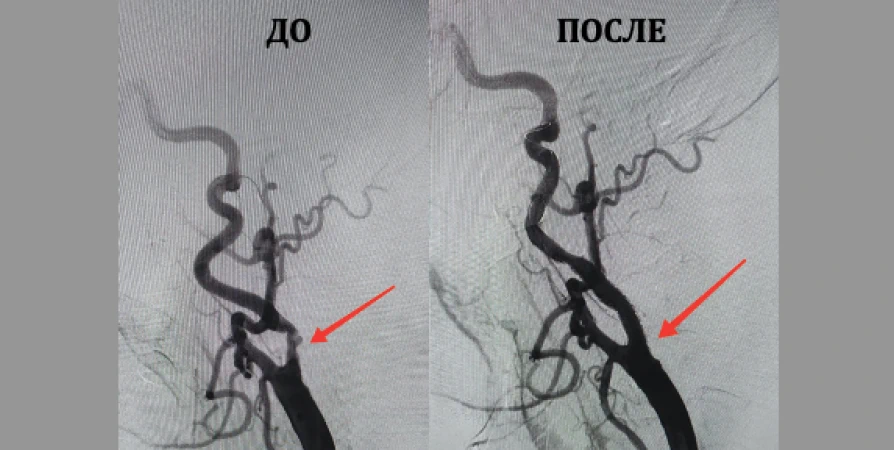 72-летнему пенсионеру первому в мурманской «Пироговке» сделали стентирование сонных артерий